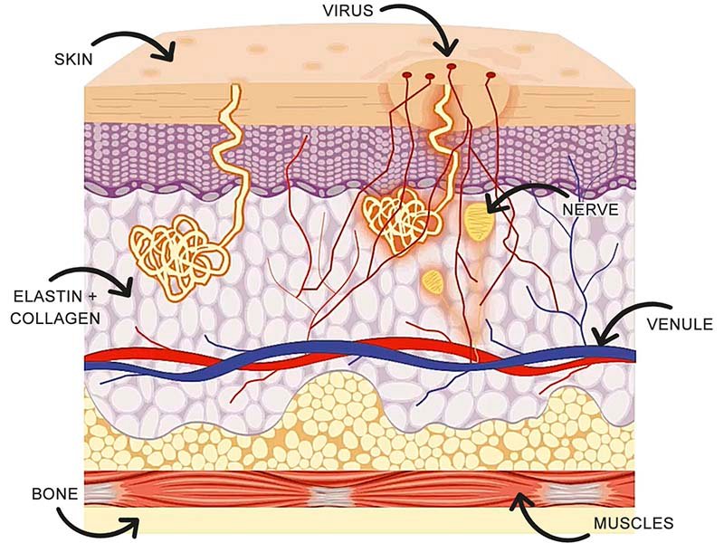 Vorter er små, hårde og ofte ujævne hudvækster, der forårsages af forskellige typer af humant papillomavirus (HPV). De kan opstå overalt på kroppen, men er mest almindelige på hænder og fødder. Vorter er generelt ufarlige og smertefri, men kan være smitsomme og æstetisk generende.